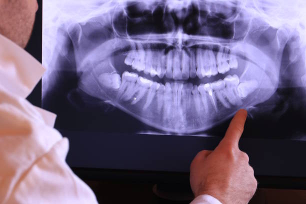 Best Emergency Tooth Extraction in Fullerton, NE