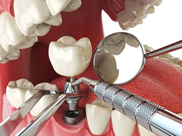 Best Emergency Dental Care for Broken or Chipped Teeth in Fullerton, NE